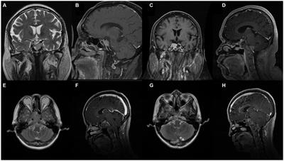 Frontiers Case Report Identification Of Potential Prognosis Related